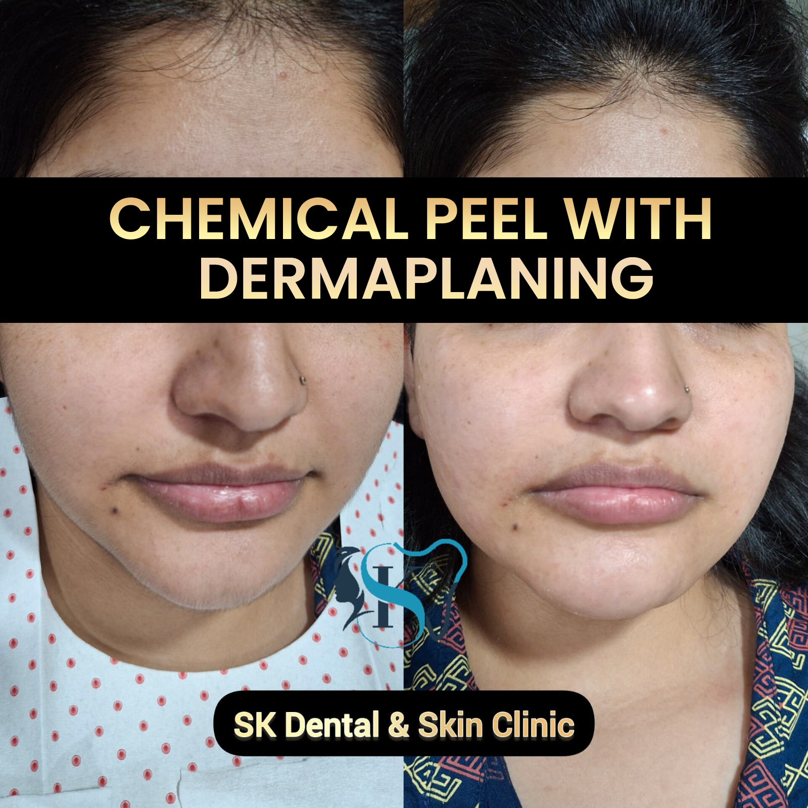 Chemical Peel Treament