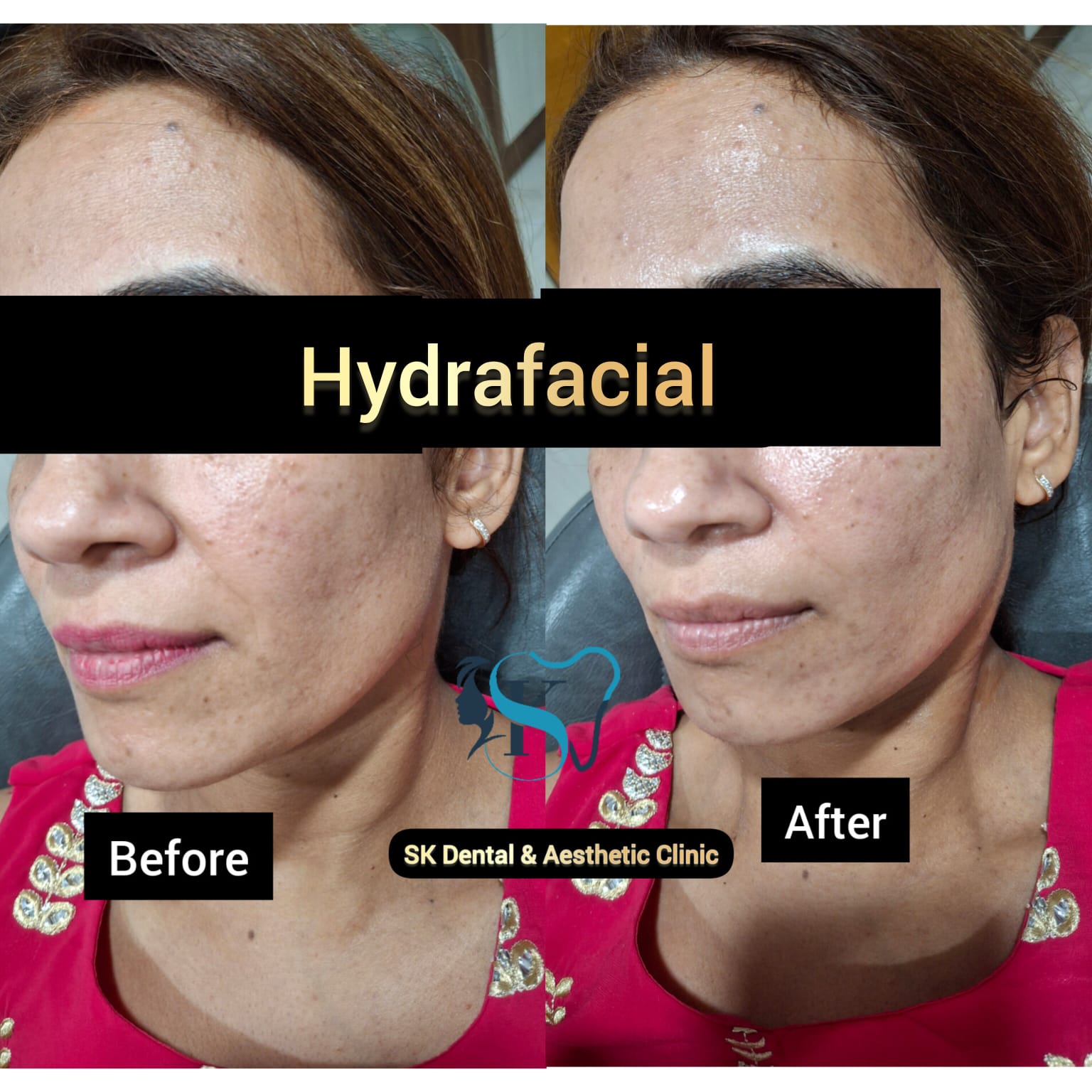 Hydrafacial Treatment