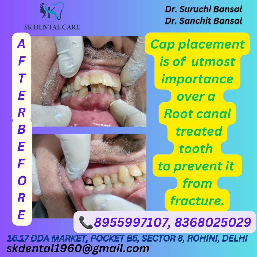 Teeth Capping Services