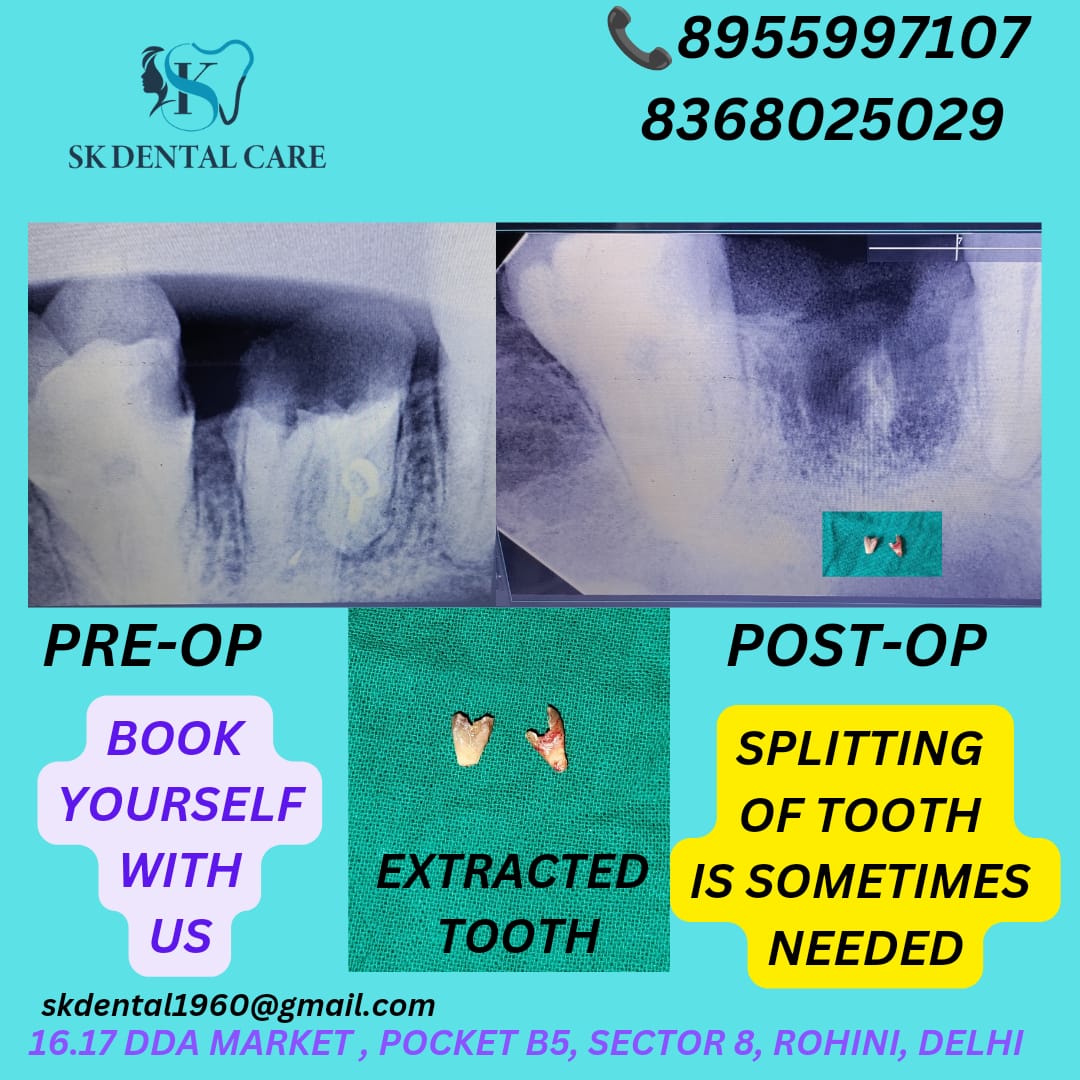 Tooth Extraction